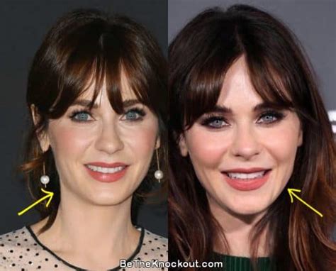 zooey deschanel filler|Zooey Deschanels plastic surgery